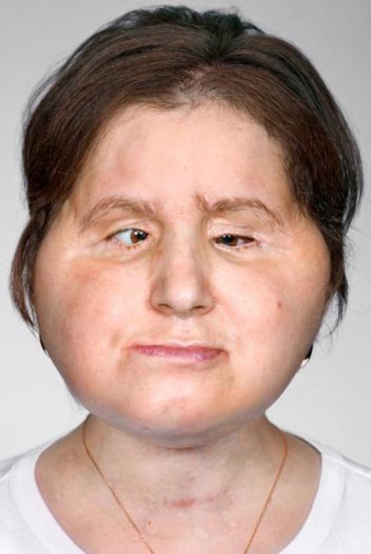 O Transplante de rosto de Katie Stubblefield