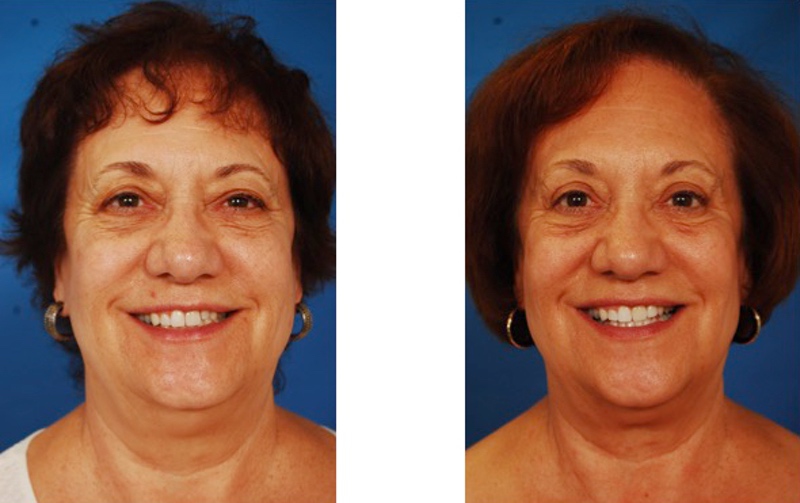 Rejuvenescimento facial pode te deixar mais atraente, simpática e confiável, segundo estudo.