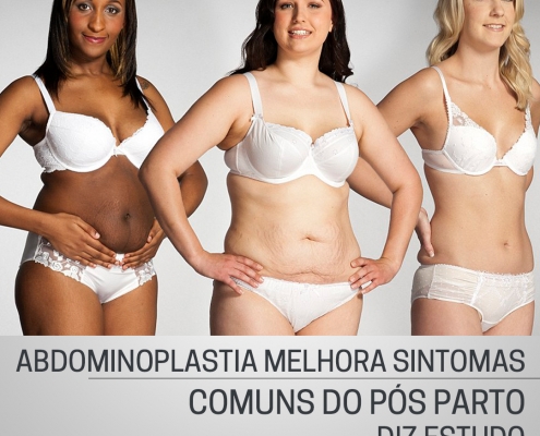 ABDOMINOPLASTIA MELHORA SINTOMAS COMUNS DO PÓS PARTO