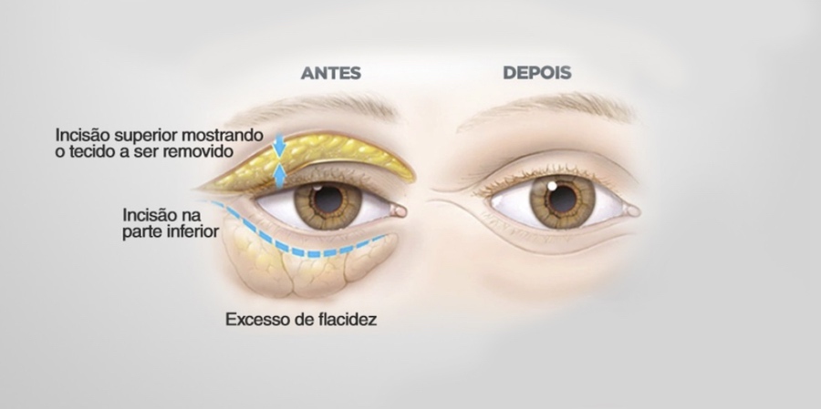 Ptose Palpebral: O que causa excesso de pele flacidez nos olhos que atrapalham a visão?