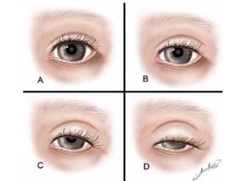 Ptose Palpebral: O que causa excesso de pele flácida nos olhos que atrapalha a visão?