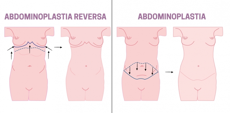 Você conhece a Abdominoplastia Reversa?
