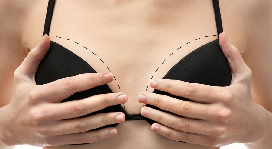 Como corrigir mamas tuberosas: alteração no desenvolvimento das mamas