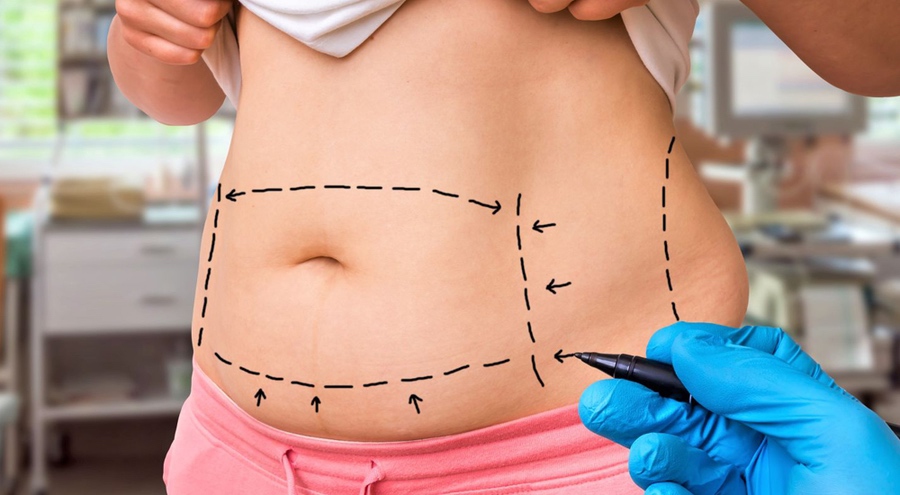 Ganho de peso após Lipoaspiração: Quais áreas do corpo engordam?