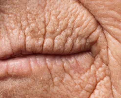 Envelhecimento Dos Labios Dra Marcela Scarpa Explica
