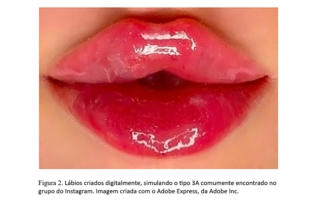 Instagram Afeta Desejo Por Preenchimento Labial Dura Pouco Dra Marcela Scarpa Explica Figura 2