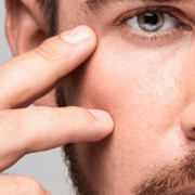 Dra Marcela Scarpa Cirurgia De Palpebras E Lifting De Sobrancelhas Em Homens Blog 1