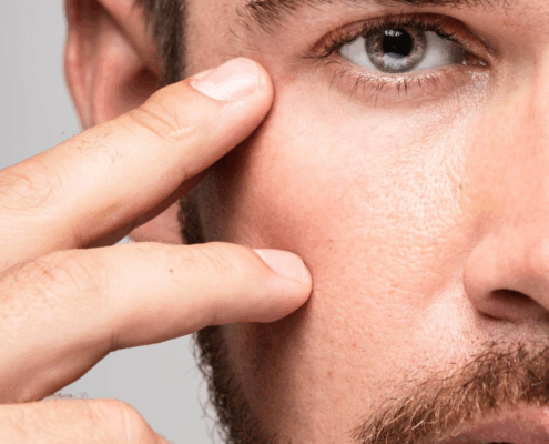 Dra Marcela Scarpa Cirurgia De Palpebras E Lifting De Sobrancelhas Em Homens Blog 1