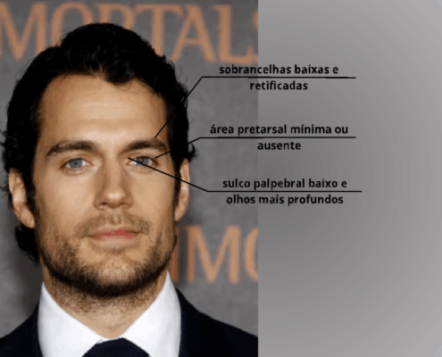 Dra Marcela Scarpa Cirurgia De Palpebras E Lifting De Sobrancelhas Em Homens Blog 2