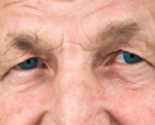 Dra Marcela Scarpa Cirurgia De Palpebras E Lifting De Sobrancelhas Em Homens Blog 3