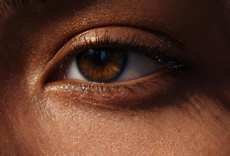 Blog Dra Marcela Scarpa Cirurgia Plastica E Saude Blefaroplastia 1