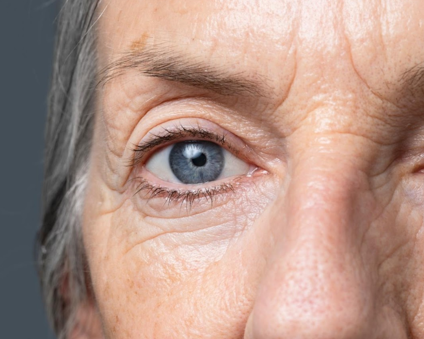 Blog Dra Marcela Scarpa Cirurgia Plastica E Saude Blefaroplastia Em Mulheres 2