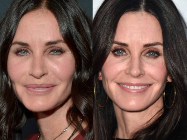 Blog Dra Marcela Scarpa Cirurgia Plastica E Saude Preenchimento Acido Hialuronico 2