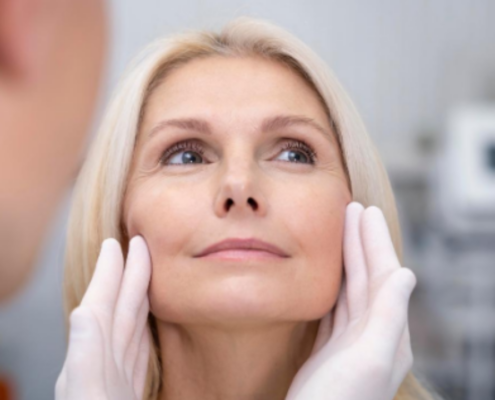 2deep Plane Facelift Lifting Facial Profundo Para Rejuvenescimento Natural E Duradouro Dra Marcela Scarpa Cirurgia Plastica Em Sao Paulo