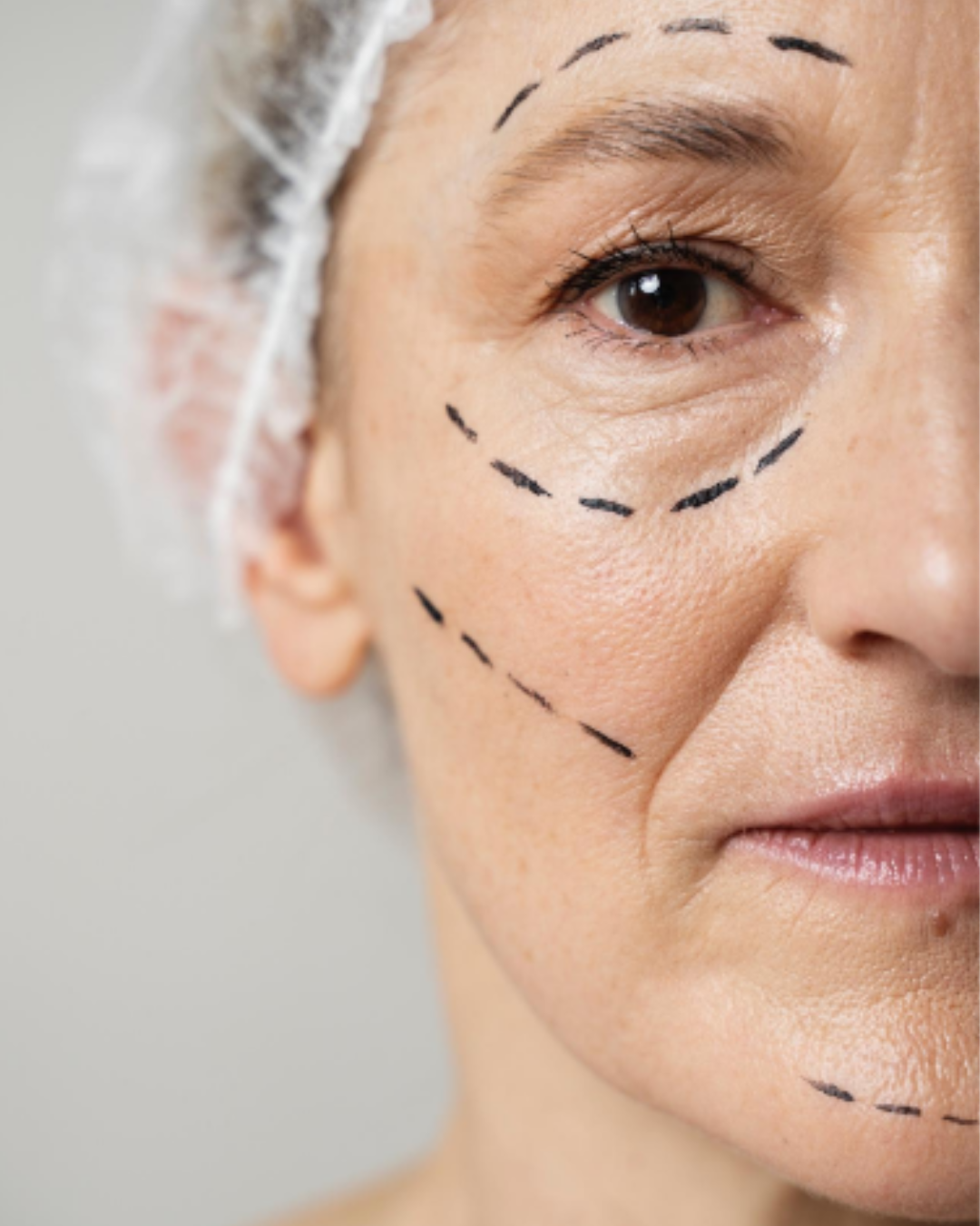 Deep Plane Facelift Lifting Facial Profundo Para Rejuvenescimento Natural E Duradouro Dra Marcela Scarpa Cirurgia Plastica Em Sao Paulo