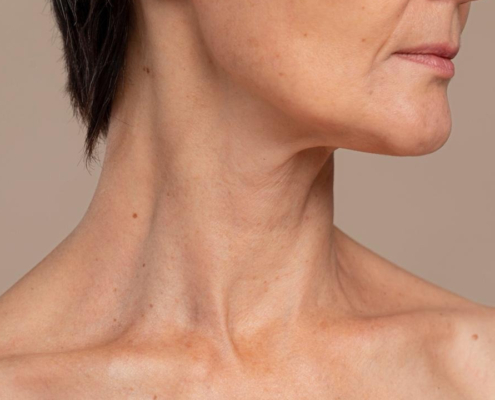 Site Blog Dra Marcela Scarpa Cirurgia Plastica Deep Neck A Cirurgia Que Redefine O Pescoc O E A Papada Tratamento Avancado Do Turkey Neck